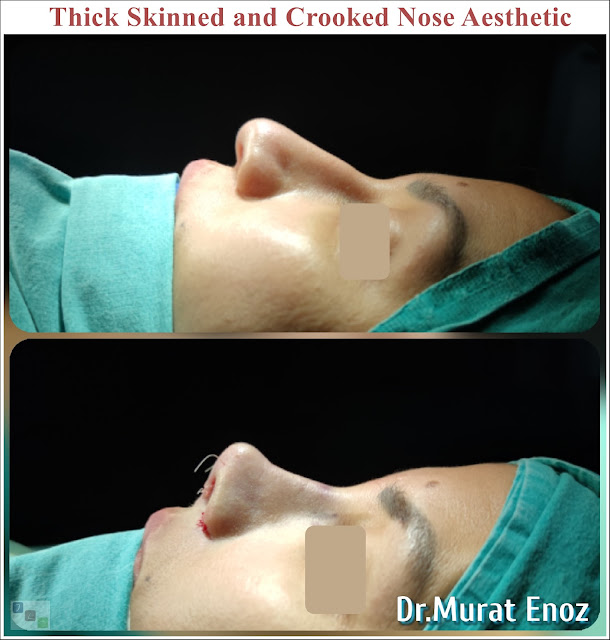 Thick Skinned and Crooked Nose Aesthetic - Natural Rhinoplasty