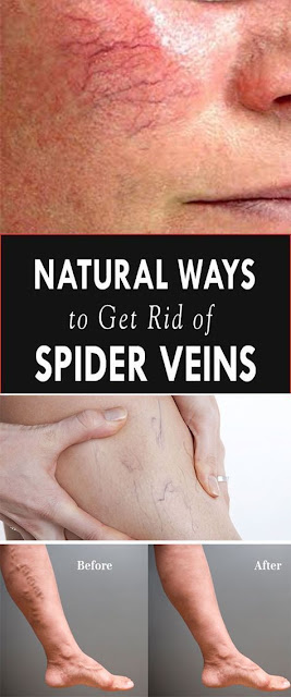 Natural Ways to Get Rid of Spider Veins At Home