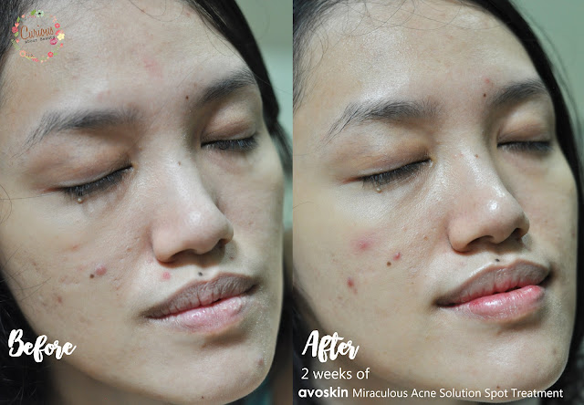 Avoskin Miraculous Acne Solution Spot Treatment Before After