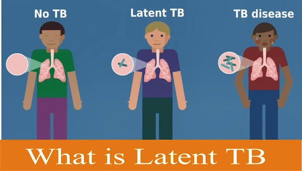 Latent TB cause and symptoms