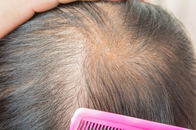 Hair Loss Treatment