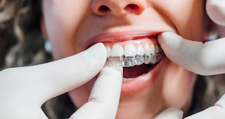 Niềng răng invisalign có tốt không-3