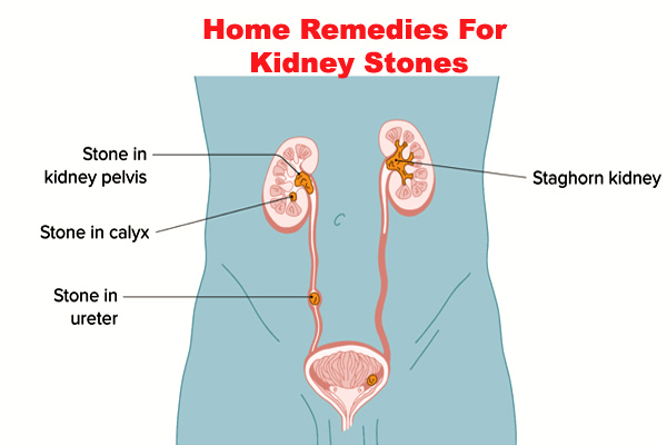 Home Remedies For Kidney Stones