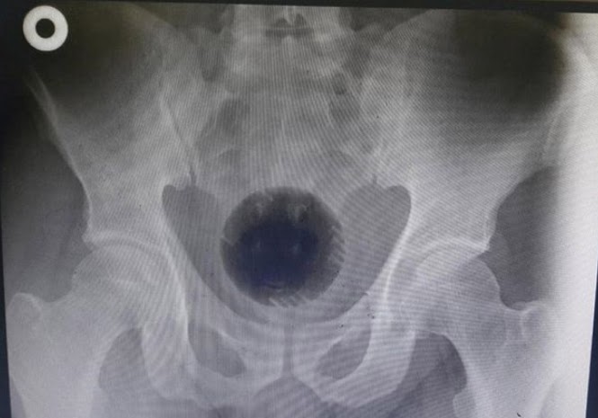 Doctors use an electric drill to remove a plastic ball from a man's b•um after surgery failed