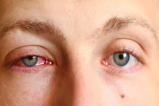 Bộ Y tế hướng dẫn phòng bệnh đau mắt đỏ trong mọi tình huống