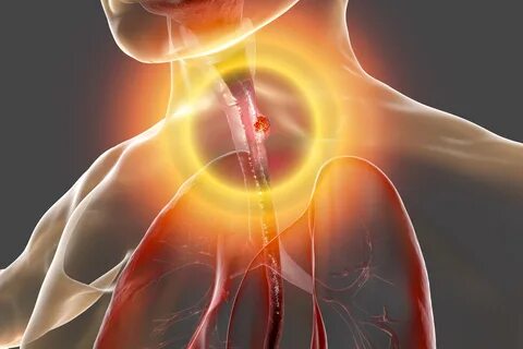 Gastroesophageal reflux disease (GERD) is a digestive disorder characterized by repeated prolonged reflux of gastric acid. High stomach acid can blur and irritate the inside of the esophagus. As a result, there is a feeling of heartburn, which feels hot, a burning sensation in the throat (heartburn), and a sour taste in the mouth. Everyone can produce different amounts of stomach acid. However, the production rate tends to increase after a meal because acid is necessary for the digestive process. Then the stomach acid will immediately decrease again. However, an increase in stomach acid can also be a sign of indigestion if it occurs frequently or repeatedly. This is what is meant by gastroesophageal reflux disease, which is GERD. Reflux acid reflux can be classified as mild GERD if it occurs approximately 2-3 times a week. However, the condition is considered severe if the stomach acid rises at least once a week. How common is this condition? GERD is a digestive problem that is quite common and can affect anyone, both men and women. However, the risk of developing GERD is usually higher in people who: •	overweight or obese, •	have connective tissue disorders (scleroderma), •	pregnant, •	active smoking •	drink alcohol often. You can reduce your risk of developing acid reflux disease by avoiding and controlling your risk factors. Contact your doctor for more information. Signs and symptoms What are the signs and symptoms of GERD? The main symptom of GERD is when the stomach acid, which must remain at the bottom of the stomach and rises back. This is due to the opening of the separating muscles between the stomach and esophagus. Acid leakage causes burning in the intestines and chest (heartburn), spreading to the stomach and back. This usually gets worse when you finish eating, lying down, or leaning over. Generally speaking, the symptoms of gastroesophageal reflux disease (GERD) are as follows. •	Feeling that food is stuck in the esophagus, difficulty swallowing, and hiccups. •	A burning sensation in the chest (heartburn) can spread to the neck. •	Pain or pain in the intestines. •	There is a liquid or food that rises from the stomach to the mouth. •	Hoarseness. •	Sore throat. There may be other signs and symptoms of GERD that were not mentioned above. If you are concerned about a particular symptom, see a doctor immediately. When to see a doctor? Seek medical attention immediately if you experience symptoms such as shortness of breath and chest pain. Especially if the symptoms of this disease often appear or even worsen with each passing day. Everyone's body condition is very different. This is what makes the symptoms that everyone feels different. Always consult your doctor for signs to get the best treatment for your health. Causes and risk factors What causes GERD? As mentioned earlier, acid reflux from the stomach is a common phenomenon. This condition is most often caused by the habit of eating large portions, lying down immediately after eating, or consuming certain foods. The difference is that an increase in stomach acid, classified as GERD, has its causes. The leading cause of GERD is the weakening of the cardiac sphincter, the annular muscles lining the stomach and esophagus. The cardiac sphincter should always be kept closed to prevent acid reflux and digested food back into the esophagus. This valve will only open when food enters the stomach in the mouth. In people with GERD, the opposite is true. The muscles of the cardiac sphincter become weak, so the sphincter can open even if the food does not move from the esophagus. If this condition persists, stomach acid can cause inflammation and irritation of the oesophageal wall (esophagitis). This is because stomach acid is a strong acid that is eroded. What increases the risk of human acid reflux? GERD can affect anyone and is usually more common in adults. However, several factors make a person susceptible to this disease. The various risk factors that increase the risk of developing GERD are as follows. •	Are you overweight or obese? •	Has a bulge in the upper abdomen, which can rise to the diaphragm (diaphragmatic hernia)? •	Having connective tissue problems, such as scleroderma. •	For a long time, emptying the stomach. •	In addition, below are some other factors that can worsen the symptoms of GERD. •	Smoking. •	Eat plenty of food at once. •	Time to eat too close to sleep. •	Overeating food that causes stomach acid, such as spicy, sour, fatty, and fried foods. •	Drink coffee or tea. •	Drink alcohol. They were taking nonsteroidal anti-inflammatory drugs (NSAIDs), such as aspirin, ibuprofen, or naproxen. What tests are usually performed to diagnose this disease? Mild symptoms of GERD can usually be treated with over-the-counter medications. However, if symptoms worsen and recur, your doctor will most likely recommend several tests to diagnose the cause. The various tests to detect GERD are as follows. Endoscopy Endoscopy is performed by inserting a flexible tube equipped with a small chamber into the esophagus. The doctor may also perform other procedures during endoscopy, such as taking a tissue sample (biopsy) to detect Barrett's esophagus. Manometry of the esophagus This procedure is performed by inserting a flexible tube into the esophagus. The test results will show how well the esophagus works, mainly whether the muscles can move food smoothly into the stomach.  Measuring the pH of the esophagus This test is performed by inserting a monitor into the esophagus to determine when stomach acid rises back through the esophagus. The pH value will show how acidic your esophagus is. Image tests X-ray tests or an X-ray of the digestive system are done to see the general picture of the esophagus, stomach, and upper intestine. This test also often involves the use of barium fluid to refine the structure of the digestive tract. What are my treatment options for this disease? The first step that is usually taken to treat GERD is drug use. If drug use does not work, your doctor will usually suggest specific procedures to address the problems directly in your stomach. 1. Take over-the-counter medications Most GERD medications work by reducing the amount of acid your stomach produces. In addition, several types of other over-the-counter drugs for the treatment of GERD are as follows: Antacids This drug helps neutralize stomach acid with alkaline chemicals. The alkaline nature of antacids will increase the pH of the stomach and prevent further damage to the stomach from the effects of acids. However, taking antacids alone is not enough to restore an inflamed esophagus through stomach acid. It should also not be taken too often as it can cause side effects like diarrhea, constipation, and kidney problems. 2. Take prescription drugs Over-the-counter medications sometimes only relieve symptoms but do not prevent GERD from recurring. These medicines include famotidine, nizatidine, and ranitidine, which can only be obtained with a prescription. As a rule, these drugs are allowed to be used for a certain period under the supervision of a doctor. Although an effective drug, H-2 receptor blockers, a doctor's prescription should not be a mainstay for long-term treatment. The reason is that with long-term drug use, there is a risk of vitamin B12 deficiency and bone fractures. These types of drugs include esomeprazole, lansoprazole, omeprazole, rabeprazole, pantoprazole and dexlansoprazole. As H-2 receptor blockers Prescription PPIs are well absorbed by the body. However, there is still a risk of side effects such as diarrhea, headache, nausea, vitamin B12 deficiency, and possible hip fracture. Therefore, you must take medication as prescribed by your doctor.