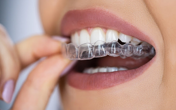 Teeth aligners