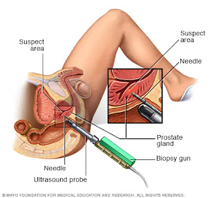 Prostate Cancer Treatment