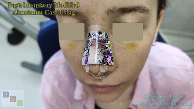 Modified Aluminum Cast, Postrhinoplasty Cast Using,Effect of postrhinoplasty taping on swelling in patients with thick skinned nose,Nostril Retainer,