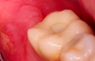 Lợi trùm răng ở trẻ em có nguy hiểm không?-1