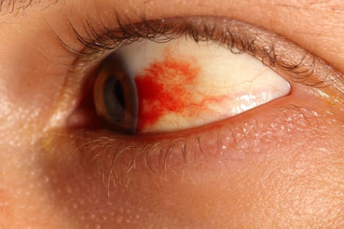 chống bệnh đau mắt đỏ và cách phòng bệnh đau mắt đỏ