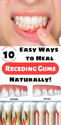 10 Easy Ways to Heal Receding Gums Naturally