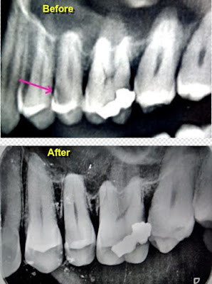 My_dental_x-rays-before&after