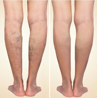 What is varicose vein removal? 4 of the best treatments to consider_Ichhori.com