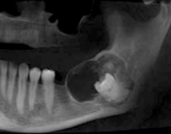 PDF: Fibroma Odontogénico Central, tipo WHO: Reporte de un caso y revisión de la literatura
