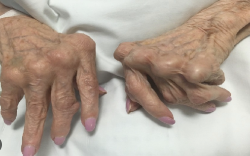 How Does Stress Affect Rheumatoid Arthritis?