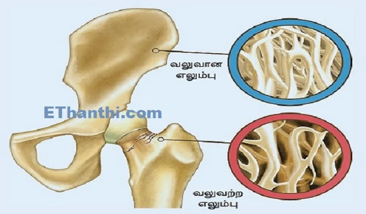 எலும்பு வலுவிழப்பு நோய் என்றால் என்ன?