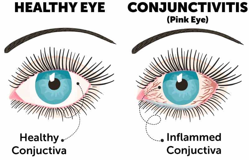 Pink Eye (Conjunctivitis) - Causes, Types, Symptoms