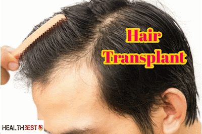 Hair Transplant | Procedure | Recovery | Instructions