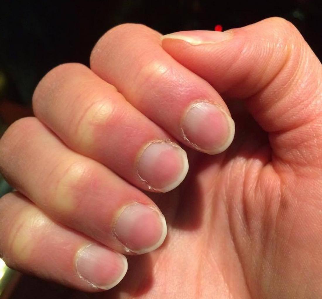 对半甲或半截甲（half-and-half nail），也称林赛氏甲（ Lindsay’s nails）