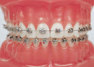 Quy trình niềng răng mắc cài kim loại-2