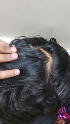 Hair fall treatment