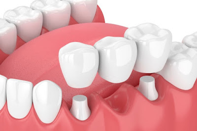 Trồng răng hàm giá bao nhiêu với cầu răng sứ? 1