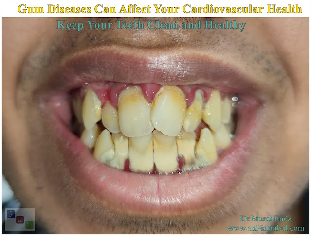 Cardiovascular Health,Gum Disease, Heart Disease, Coronary Artery Disease, Atherosclerosis ,