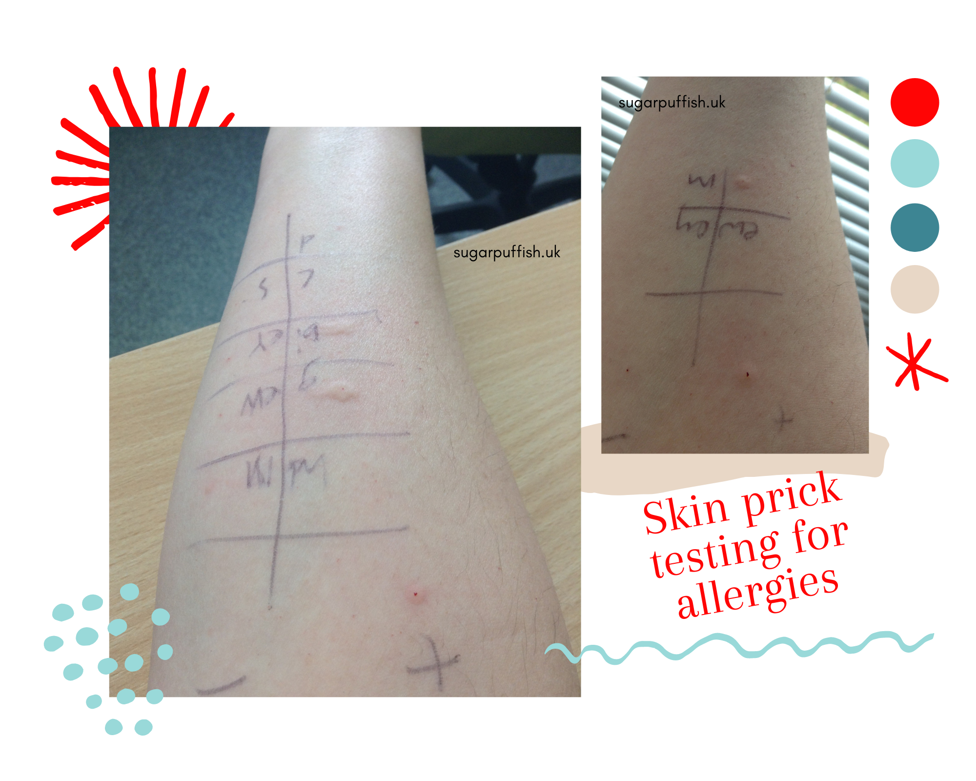 skin prick tests for allergies