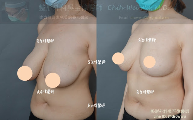 提乳手術案例