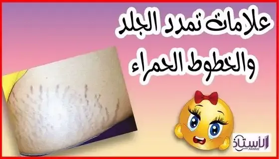How-to-get-rid-of-stretch-marks-during-pregnancy
