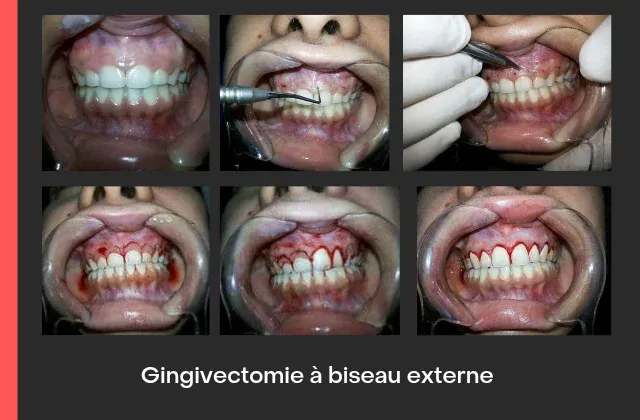 Gingivectomie à biseau externe