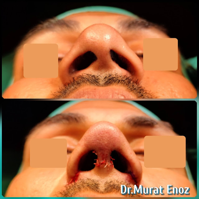 Natural nose aesthetic surgery for male,Male thick skinned rhinoplasty,Ethnic expert rhinoplasty surgeon,Ethnic Rhinoplasty in Istanbul,