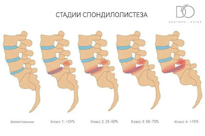 Многоуровневое смещение позвонка вперед известно как антеролистез.