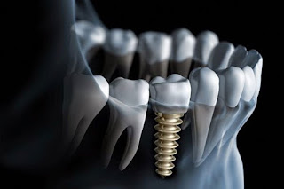 Cấy ghép răng implant đạt chuẩn-1