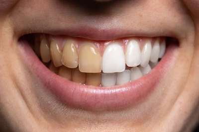Tips Memutihkan Gigi Secara Alami