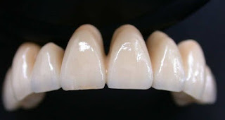 Những trường hợp nên bọc răng sứ-2