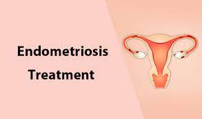 Endometriosis Treatment