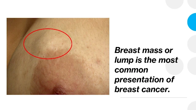 Most breast cancers present with a lump within the breast.