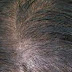 Natural treatment of early and genetic baldness in women, hair transplantation, plasma and herbs