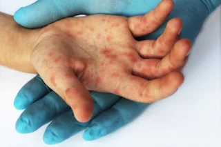 Hand, Foot and Mouth Disease