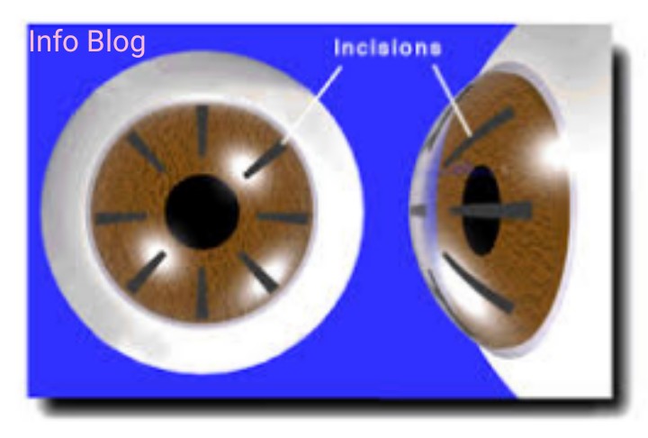 Radial Keratotomy