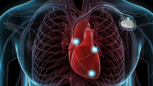 Implantable Cardioverter-defibrillators Market