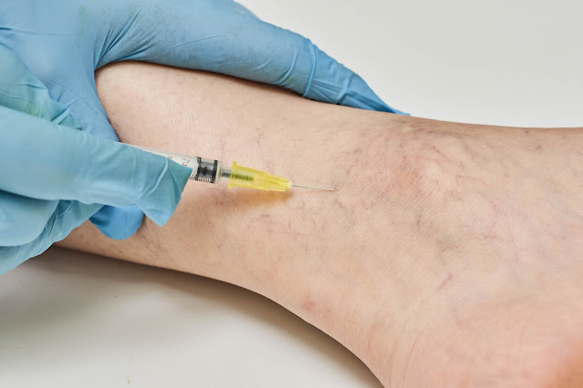 Varicose Vein Treatment In Houston, Texas