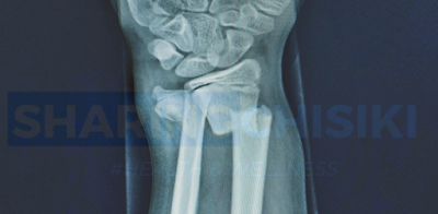 Fractures
