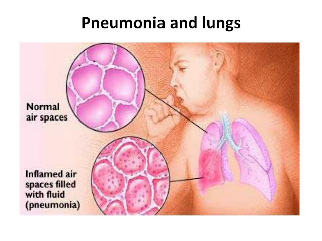 WHAT IS PNEUMONIA AND ITS TREATMENT