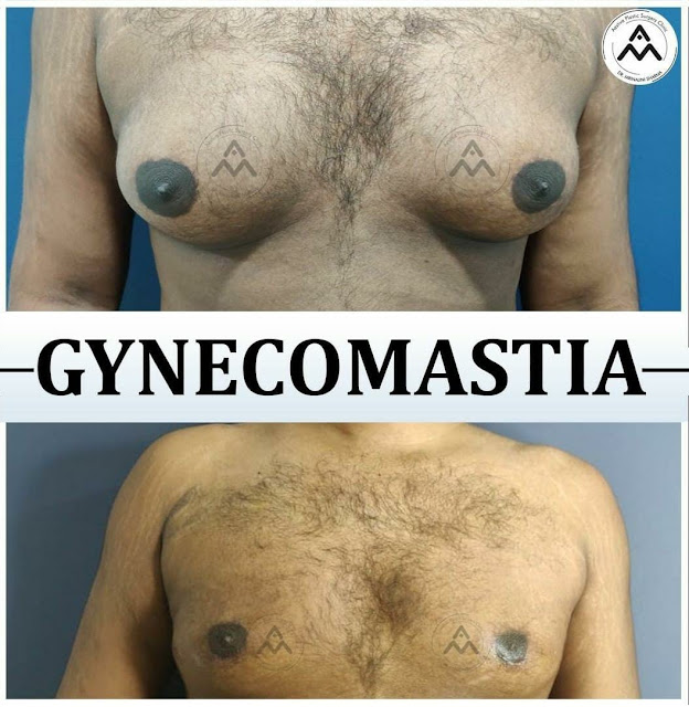 Best Gynecomastia Surgeon in Delhi