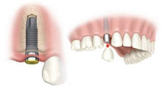 Cấy ghép răng Implant -1