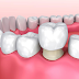 Nên làm cầu răng hay trồng Implant - Lựa chọn tốt cho nụ cười hoàn hảo