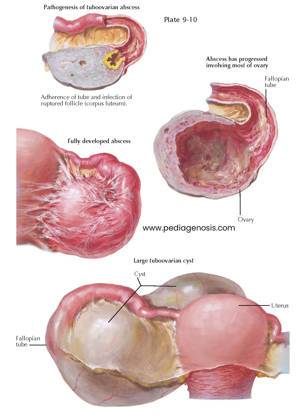 TUBOOVARIAN ABSCESS